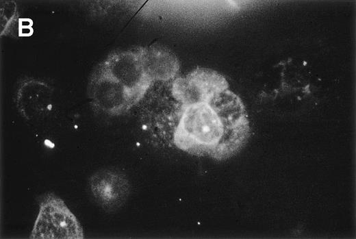 Fig. 6. Double-immunofluorescence staining of PBMC from an HCL patient. Cell smears were fixed in acetone and incubated with a Cy3-labeled mouse anti-CD11c MoAb and a mouse anti-bFGF MoAb followed by the TS amplification system (see Materials and Methods). Green (A, anti-bFGF) and red (B, anti-CD11c) fluorescent signals from the same field were recorded sequentially. Experiments using isotype control antibodies or PBMC from an HD were negative (not shown).