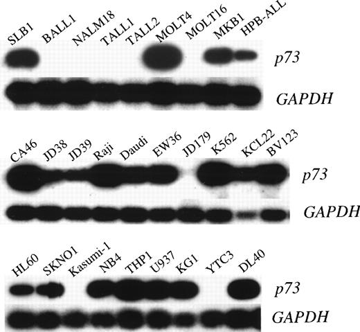 Fig. 1. p73 expression in pre B/B-ALL, T-ALL/LBL, and B-NHL cell lines. Autoradiography of RT-PCR products (390 bp) of thep73 gene is shown in the top panels and GAPDH in the bottom panels.