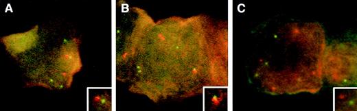 Fig. 1. FISH analysis with a probe set for MBCR andABL, in blasts from a patient with recently treated acute lymphoblastic leukemia shown to be Philadelphia-chromosome–negative and BCR/ABL-negative. The digoxigenin-labeled probe forBCR is detected with anti-dig rhodamine (red), and the biotinylated probe to ABL is detected with fluoreceinated avidin (green). The 3 illustrations represent cells in late S- (A and B) and G2M-phase (C) of the cell cycle. In (A), there are 4 green and 3 red signals with close proximity of BCR/ABL(inset). In (B), there are 4 green and 3 red signals, including a doubling BCR (red) signal which is juxtaposed to ABL(inset). The cell in (C) is at G2M and shows 4 green and 4 red signals with no juxtaposition of BCR and ABL.