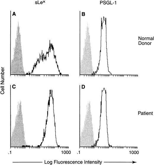 Fig. 2. Neutrophil expression of sLex and PSGL-1. The surface expression of sLex (A and C) and PSGL-1 (B and D) on neutrophils from a normal donor (A and B) and the patient (C and D) was determined by FACS analysis. Filled and unfilled tracings represent, respectively, the background staining and staining for the targeted protein. For the normal donor and the patient comparable levels of expression of sLex and PSGL-1 were noted.