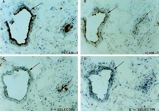 Fig. 6. Expression of endothelial cell adhesion molecules in inflamed tissues. Serial tissue sections from visually and histologically inflamed ulcerated tissue removed at the time of the patient’s below-the-knee amputation were stained immunohistochemically with antibodies against PECAM-1 (A), ICAM-1 (B), P-selectin (C), and E-selectin (D). Two vessels (long and short arrows) are identified by staining with antibody against PECAM-1. Although ICAM-1 expression (B, long arrow) and P-selectin expression (C, short arrow) were detected on the vasculature, no expression of E-selectin was detected on these or other vessels in the surrounding tissue. Staining with 3 anti–E-selectin antibodies gave similar results.