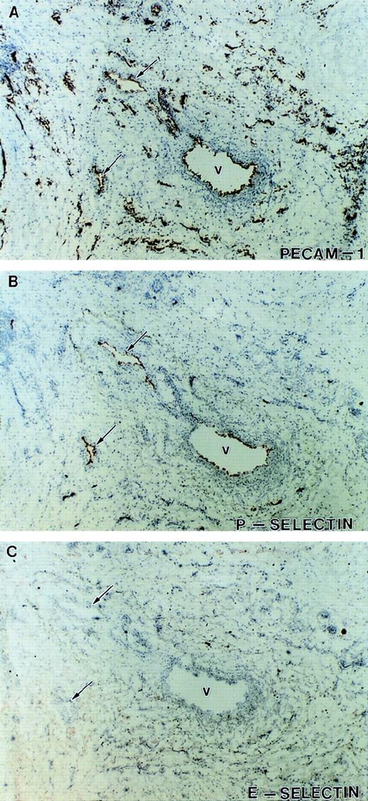 Fig. 7. Expression of P-selectin and E-selectin in inflamed tissue. Immunohistochemical staining of serial tissue sections from another sample of visually and histologically inflamed ulcerated tissue different from that presented in Fig 5. Shown are sections stained with antibodies against PECAM-1 (A) to identify the vessels, P-selectin (B), and E-selectin (C). Although a subpopulation of the vasculature expressed P-selectin (V and arrows), no significant expression of E-selectin was detected on any of the vessels in this tissue.