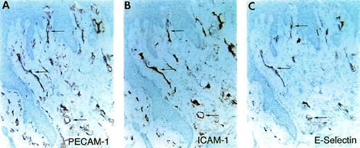 Fig. 9. Expression of E-selectin in a chronic ulcer. Immunohistochemical staining of serial tissue sections of a sample of visually and histologically inflamed tissue from the margin a diabetic chronic nonhealing wound/ulcer. Sections stained with antibodies against PECAM-1 (A) to identify the vessels, ICAM-1 (B), and E-selectin (C). In this inflamed tissue, E-selectin was detected on a subpopulation of the vasculature (arrows).