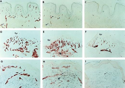 Fig. 10. Expression of E-selectin in TNF-–stimulated skin organ cultures. Immunohistochemical staining of skin organ cultures stimulated for 8 hours with TNF- (12,000 U/mL). Serial sections of unstimulated normal skin (A through C), stimulated normal skin (D through F) and stimulated skin from the patient (G through I) were stained with antibody against PECAM-1 (A, D, and G) to identify the vessels (arrows and arrowheads), ICAM-1 (B, E, and F) and E-selectin (C, F, and I). The epidermis (Epi) is indicated for the stimulated normal skin. In unstimulated normal skin there was some expression of ICAM-1 (B, arrowheads), although most of the vessels did not express it (B, double arrows), and negligible expression of E-selectin (C). A similar pattern was seen for unstimulated skin from the patient (data not shown). In stimulated normal skin, there was marked upregulation in the number of vessels expressing ICAM-1 (E) and a smaller but clearly significant increase in the number of vessels expressing E-selectin (F). In contrast to normal skin, stimulated skin from the patient showed upregulation of ICAM-1 on the vasculature (H) but no increased E-selectin expression (I). The asterisk indicates dermal interstitium in which there is also upregulate expression of ICAM-1 on the dermal stroma particularly evident in the sample of stimulated normal skin (E).