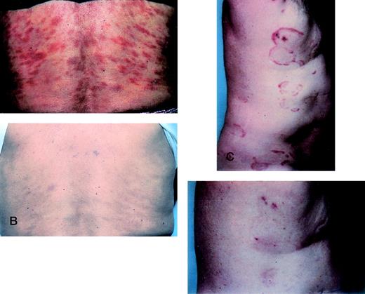 Fig. 1. CRs of 2 patients during treatment with rhIL-12. (A) Patient 7 before starting rhIL-12. (B) Patient 7 at the conclusion of treatment with rhIL-12 showing complete clearing of skin lesions on the trunk. (C) Patient 6 before initiating rhIL-12. (D) The same patient at week 10 of therapy with complete clearing of skin lesions.