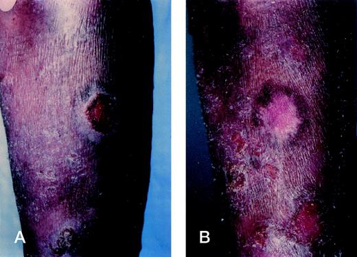 Fig. 2. Intralesional injections of rhIL-12 result in tumor regression. (A) Tumor of the right forearm at baseline in patient 5. (B) Complete flattening of the tumor at week 3 after 6 injections of rhIL-12 at a dose of 100 ng/kg into the tumor. Histologic examination of the flattened tumor showed complete resolution of the malignant infiltrate.