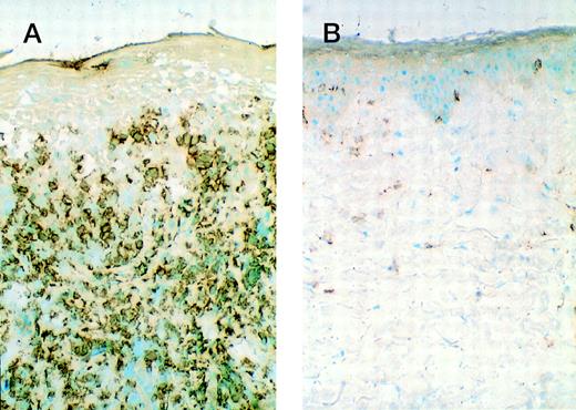 Fig. 3. CD3+ cells within involved skin lesions decrease during lesion regression while receiving rhIL-12. (A) Biopsy specimen of involved skin from patient 6 at baseline. (B) Biopsy specimen of same lesion as in (A) when lesion was nearly completely resolved during rIL-12 treatment.