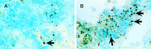 Fig. 4. TIA-1+ cells increase significantly within regressing skin lesions during rhIL-12 treatment. (A) Involved skin at baseline from patient 8 with small numbers of TIA-1+cells as indicated by the arrow. (B) A 2- to 3-fold increase in the proportion of TIA-1+ cells as indicated by the arrows within the same lesion during regression associated with rhIL-12 treatment.