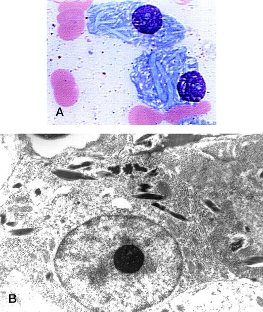 Crystalloid cytoplasmic inclusions in myeloma marrow. A 70-year-old woman was diagnosed with indolent multiple myeloma (IgG, kappa) in 1994. She had been followed without treatment, but recently developed mild azotemia. Bone marrow examination revealed 17% plasmacytosis. The light (original magnification × 1,000) and electron (original magnification × 13,680) microscopic photographs of marrow plasma cells showed crescent-like cytoplasmic inclusions. The patient had low serum bicarbonate and uric acid levels as well as elevated urine lysozyme. These findings suggested an acquired Fanconi syndrome that has been reported in association with deposition of crystallized immunoglobulin light chain in the proximal tubular cells of the kidney. Costanza and Smoller (Am J Med 34:125, 1963) presented the first electron micrographs of renal proximal tubules from a myeloma patient with the acquired Fanconi syndrome. Cytoplasmic inclusions similar to those above were present in the plasma cells and kidney of their patient. (Courtesy of Sabrina D. Phillips, MD, Joseph T. Newman, PhD, and Marvin J. Stone, MD, Baylor-Sammons Cancer Center, Dallas, TX.)
