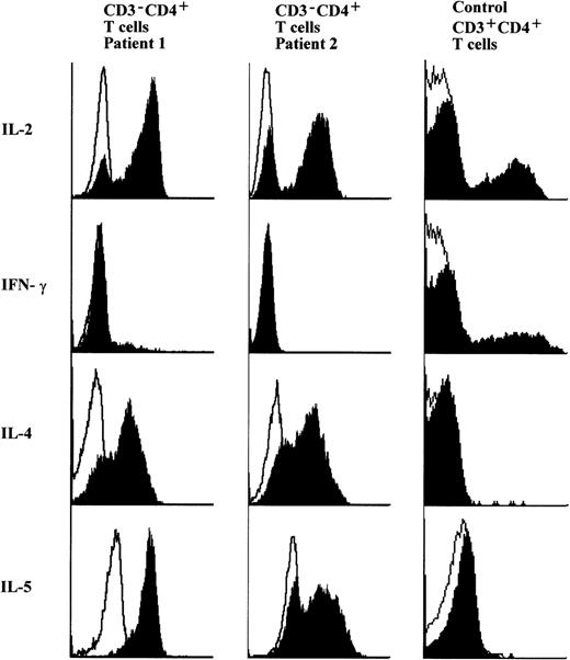 Fig. 2. Cytokine profile of clonal T cells from two hypereosinophilic patients. Total T cells (CD4+ and CD8+) were isolated from PBMC obtained from two hypereosinophilic patients and a healthy blood donor by negative selection. After a 6-hour culture (106 cells/mL) with Brefeldine A (10 μg/mL) in the absence or in the presence of PMA (50 ng/mL) and A23187 (0.1 μg/mL), cell membranes were stained with FITC- or PE-conjugated anti-CD8 and PerCP-conjugated anti-CD3 MoAbs. The T cells were fixed and permeabilized before staining cytokines with PE- or FITC-conjugated MoAbs against IL-2, IFN-γ, IL-4, or IL-5. Intracytoplasmic expression of cytokines was analyzed by flow cytometry after gating on CD3−CD8− (equivalent to CD3−CD4+) lymphocytes for patients and CD3+CD8− (equivalent to CD3+CD4+) lymphocytes for the control subject. Filled histograms represent staining for cytokines in cells that have been stimulated with PMA and A23187. Negative controls (solid lines) are provided by unstimulated cells that have been incubated in the presence of Brefeldine A alone.