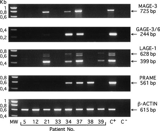 Fig. 1. RT-PCR amplification products of the indicated genes obtained with bone marrow samples from 8 different patients with MGUS (no. 5), myeloma stage I (no. 12), or myeloma stage III (nos. 21 through 39). C+, positive control melanoma line (MZ2-MEL for MAGE-A3, GAGE-3/6, and β-ACTIN; LB373-MEL for LAGE-1 and PRAME). C−, negative control (no RNA present in the RT reaction). MW, molecular weight marker is SmartLadder (Eurogentec, Seraing, Belgium). Amplifications of MAGE-A3, GAGE-3/6, PRAME, and β-ACTIN transcripts give unique bands of 725, 244, 561, and 615 bp, respectively. Amplification of LAGE-1 transcript gives 2 bands that correspond to fully spliced (399 bp) and partially spliced (628 bp) mRNA, respectively, and a band of approximately 600 bp representing heteroduplexes formed during PCR between the products amplified from the partially and the fully spliced cDNAs.