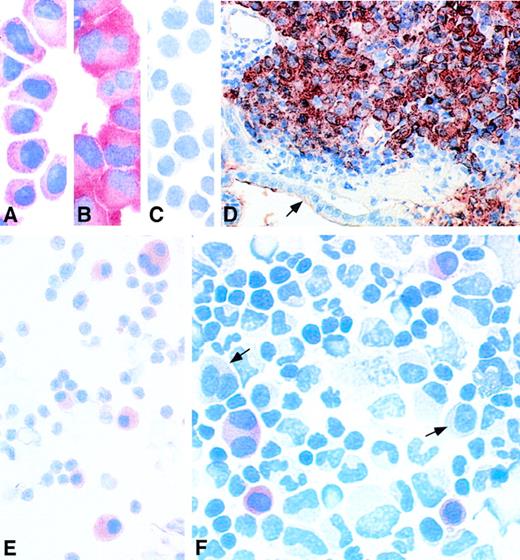 Fig. 3. Immunocytochemistry performed on myeloma samples with anti-MAGE monoclonal antibody 57B. (A) MAGE+ myeloma cell line EJM. (B) MAGE+ myeloma cell line U266. (C) MAGE− myeloma cell line Fravel. (D) Gut biopsy from patient no. 29, a patient with MAGE+ stage III myeloma treated by chemotherapy, who developed skin and gut plasmacytomas. The cells stained in brownish red are malignant plasma cells infiltrating the gut mucosa. The epithelium is indicated by an arrow. (E) Bone marrow smear from patient no. 21, a patient with MAGE+ stage III myeloma. All the plasma cells are stained in red. (F) Bone marrow cytospin from patient no. 43, who had a myeloma in relapse after 2 autografts. Some malignant plasma cells are stained in red. The arrows indicate 2 unstained myeloma cells. The slides incubated with the isotype-matched irrelevant monoclonal antibody remained negative, as did cytospins of MAGE-negative bone marrows from stage III myeloma patients incubated with antibody 57B (data not shown).