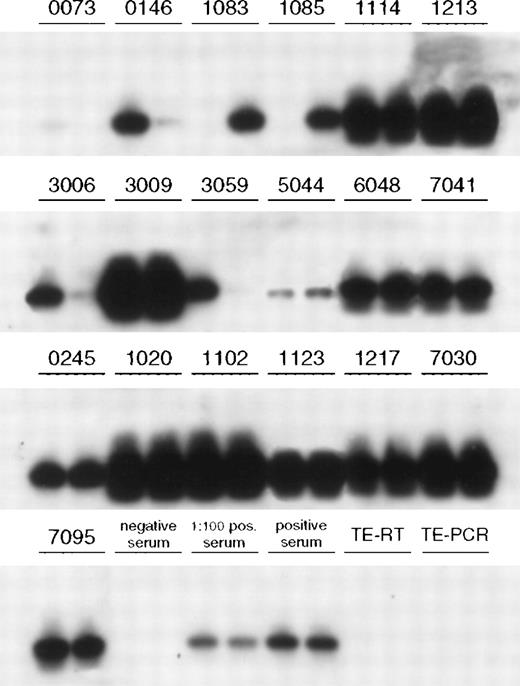 Fig. 2. Southern blot hybridization of the duplicate RT-PCR results using an internal 5′-digoxigenine–labeled HCV probe. The initially detectable PCR products in duplicate of the 19 HCV seroconverters were blotted and hybridized under high-stringency conditions. The 19 seroconverters are indicated by an identification number. Positive and negative controls are indicated.