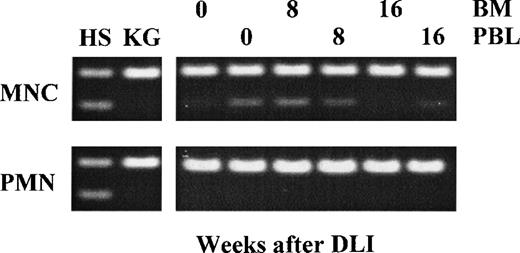 Fig. 1. Chimerism analysis in bone marrow (BM) or peripheral blood (PBL) from the patient after treatment with donor lymphocyte infusion (DLI). Cells of donor (HS) origin could be detected by AFP polymorphism (heterozygous 145 and 72 bp fragments). Temporary increase of donor cells was observed in MNC in BM at 8 weeks after DLI, but returned to pre-treatment levels at 16 weeks after DLI. PMN from the patient remained of patient origin.