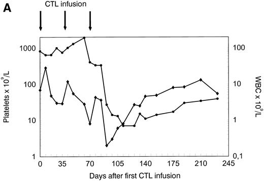 Fig. 4. Platelets, white blood cells (WBC), and PCILp before and after treatment with leukemia-reactive CTL lines 1, 2, and 3. (A) Between days 80 and 90, 10 to 20 days after the infusion of CTL line 3, a rapid decrease of (•) platelets and (⧫) WBC was observed, followed by a gradual recovery. (B) A strong increase of PCILp frequencies in PBL from the patient was observed between days 70 and 90.