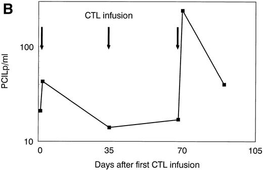 Fig. 4. Platelets, white blood cells (WBC), and PCILp before and after treatment with leukemia-reactive CTL lines 1, 2, and 3. (A) Between days 80 and 90, 10 to 20 days after the infusion of CTL line 3, a rapid decrease of (•) platelets and (⧫) WBC was observed, followed by a gradual recovery. (B) A strong increase of PCILp frequencies in PBL from the patient was observed between days 70 and 90.
