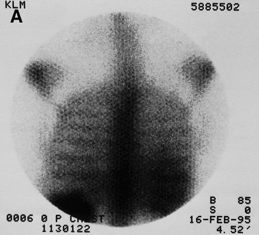 Fig. 1. 131I-anti-CD45 antibody localization. Posterior 131I-BC8 images of patient with AML in relapse (UPN 9013) immediately after trace-labeled antibody infusion (A and C) and 40 hours after infusion (B and D). Accumulation of labeled antibody is shown in the ribs, vertebral column, ilium, pelvis, and sacrum, all marrow-rich regions of the axial skeleton.