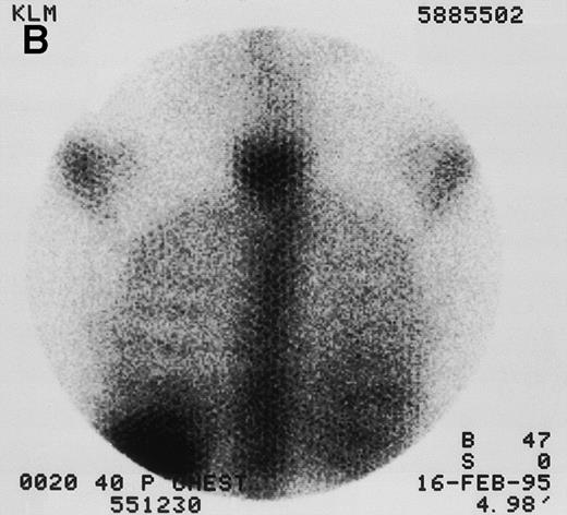 Fig. 1. 131I-anti-CD45 antibody localization. Posterior 131I-BC8 images of patient with AML in relapse (UPN 9013) immediately after trace-labeled antibody infusion (A and C) and 40 hours after infusion (B and D). Accumulation of labeled antibody is shown in the ribs, vertebral column, ilium, pelvis, and sacrum, all marrow-rich regions of the axial skeleton.
