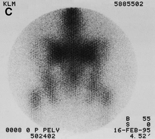 Fig. 1. 131I-anti-CD45 antibody localization. Posterior 131I-BC8 images of patient with AML in relapse (UPN 9013) immediately after trace-labeled antibody infusion (A and C) and 40 hours after infusion (B and D). Accumulation of labeled antibody is shown in the ribs, vertebral column, ilium, pelvis, and sacrum, all marrow-rich regions of the axial skeleton.