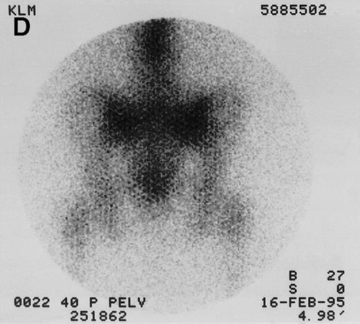 Fig. 1. 131I-anti-CD45 antibody localization. Posterior 131I-BC8 images of patient with AML in relapse (UPN 9013) immediately after trace-labeled antibody infusion (A and C) and 40 hours after infusion (B and D). Accumulation of labeled antibody is shown in the ribs, vertebral column, ilium, pelvis, and sacrum, all marrow-rich regions of the axial skeleton.