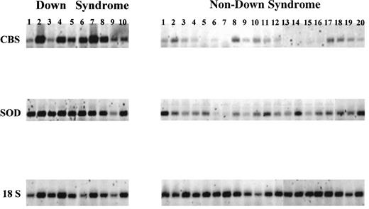Fig. 1. RT-PCR analysis of chromosome 21-localized transcript levels in myeloblasts obtained from newly diagnosed patients with AML or TMD. Lanes DS 1 through 10 and non-DS 1 through 20 correspond to the patients listed in Tables 1 and 2, respectively. CBS, cystathionine-β-synthase localized to 21q22.3 corresponding to a 655-bp product; SOD, superoxide dismutase localized to 21q22.1 corresponding to a 436-bp product. The transcript levels were normalized to 18S RNA transcript levels.
