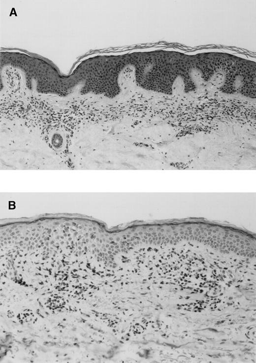Fig. 1. Biopsy specimens from SPP patient SF illustrating the diagnostic criteria compact stratum corneum with moderate acanthosis and foci of spongiosis, slightly edematous papillary dermis with a sparse band-like infiltrate composed of bland lymphohistiocytic cells, few of them epidermotropic lymphocytes, and absence of so-called Pautrier’s microabscesses. (A) Hematoxyline-eosine staining (×33); (B) CD3 staining (×50) showing the T-cell nature of the infiltrating lymphocytes.