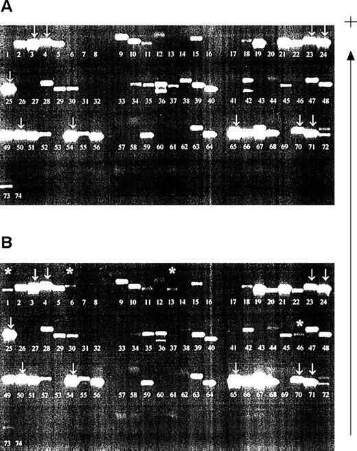 Fig. 2. Detection of microchimerism using nested PCR-SSP typing. (A) Pretransfusion DNA sample (recipient HLA type: A*0301, A*2402; B*4001, B*51011; Cw*0304, Cw*1502, all recipient bands arrowed; other bands are nonspecific). (B) Posttransfusion DNA sample (blood donor 1 HLA type: A*0101; B*0801, B*4402; Cw*0701, Cw*0704; blood donor 2 HLA type: A*2501, A*3002; B*3501, B*5501; Cw*0303, Cw*0401). Asterisked bands are those donor alleles detected; the pattern of recipient alleles and nonspecific bands is the same as that of a pretransfusion sample. Patient DNA was isolated from peripheral blood leukocytes and used in a primary amplification using HLA-A, -B, or -C primers.28 The resultant products were diluted 1:500 and used in a PCR-SSP typing system.19 The gel is run from negative (−) to positive (+).