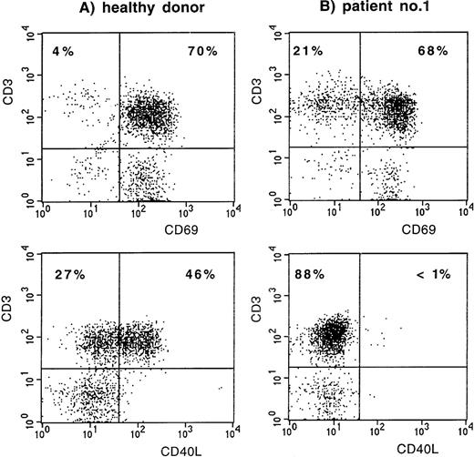 Fig. 1. CD69 and CD40L expression on CD3+ T lymphocytes after stimulation of PBMC with PMA and ionomycin. (A) Normal control. (B) Patient no. 1.