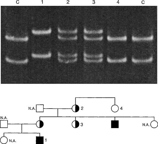 Fig. 2. Single-strand conformation polymorphism (SSCP) analysis of XHIM family A with T254M mutation. PCR products (198 bp) of exon 5 of the CD40L gene were denatured and run on a 12.5% polyacrylamide gel at 150 V for 14 hours. The 2 control (C) lanes show the positions of the DNA strands of the unaffected X-chromosome. The C → T mutation leads to a shift in the position of these bands, as is shown in lane 1 (XHIM patient no. 2). Carriers (lanes 2 and 3) show both mutated and unmutated DNA strands. Noncarriers (lane 4) only show the unmutated DNA strands.