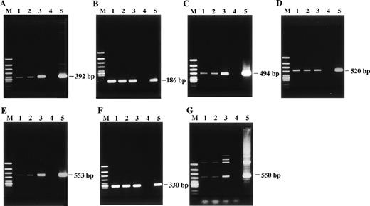Fig. 2. Detection of HHV-6 DNA by PCR with 7 distinct primer pairs that target different regions of the HHV-6 genome. The PCR products were subjected to electrophoresis and stained with ethidium bromide. The products were all of the predicted sizes. (A) HHV-6 U4 gene. (B) U31 gene. (C) U57 gene. (D) U67 gene. (E) U89 gene. (F) U94 gene. (G) HHV-6 sequence located between U91 and U92 genes. Lane 1, patient; lane 2, patient’s husband; lane 3, their daughter; lane 4, healthy adult donor as a negative control; lane 5, HHV-6B–infected cord blood cells as a positive control; lane M, ◊X174/HincII-cut DNA size marker.