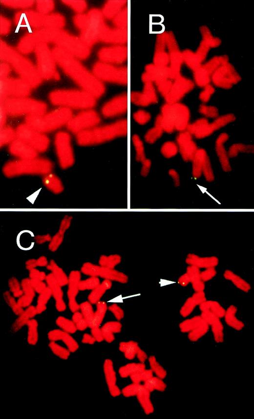 Fig. 1. FISH on metaphase chromosomes from the lymphoma patient (A), patient’s husband (B), and their daughter (C). Hybridization with an HHV-6–specific probe showed HHV-6 integration with symmetrical doublet signals at homologous sites of both chromatids. Arrow and arrow head indicate the hybridization signals on chromosome loci 1q44 and 22q13, respectively. Chromosomes were counterstained with propidium iodide.