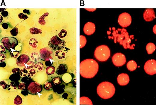 Fig. 2. (A) Bone marrow smear from a mouse 8 weeks after injection with cells from a patient with AML M4Eo showing the characteristic morphology of this subtype, including dysplastic eosinophils (black arrowhead) and leukemic blasts (white arrowheads). (B) FISH on a colony grown from the marrow of a mouse 8 weeks after injection with cells from pt 8. The probe used was D8Z2, which is specific for centromeric repeat sequences on human chromosome 8. The +8 abnormality previously identified in the leukemic clone of this patient is illustrated.