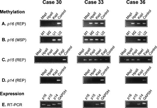 Fig. 1. Analysis of p16, p15, and p14 gene methylation and mRNA expression in 3 diffuse large BCL. The methyl-sensitive restriction enzymes used for REP are indicated (HpaII, KspI, NaeI, and EagI); digestion with the non–methyl-sensitive enzyme MspI serves as a negative control; undigested DNA (Control) serves as a positive control. For MSP, 2 primer sets specific for the methylated (M1 and M2) and 2 for the unmethylated (U1 and U2) bisulfite-modified p16gene are used. Expression of p16, p15, and p14 mRNA is analyzed by RT-PCR. The p16 gene is methylated in cases 33 and 36 but unmethylated in case 30. In case 36, p16 methylation is detected by REP but not by MSP (A and B). The p15 gene is methylated in cases 33 and 36 but not in case 30. In case 33, all assessed restriction sites are methylated. In case 36, all sites exceptEagI are methylated (C). The p14 gene is unmethylated in all 3 cases (D). GAPDH and p14 mRNA is present in all cases; p15 mRNA is detectable in case 30 but not in cases 33 and 36, whereas p16 mRNA is present in cases 30 and 36 but not in case 33 (E).