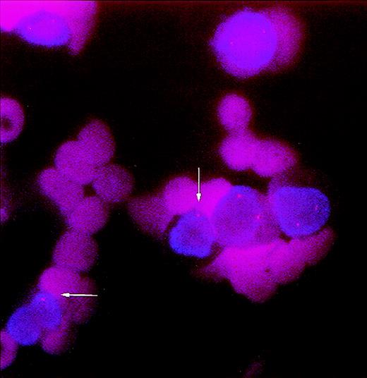 Fig. 1. Pretransplant bone marrow smear cells from patient no. 3 screened for del(5)(q31). Nucleated cells (2 of 6) show a single signal instead of the two normal signals indicating deletion 5q31 (arrows).