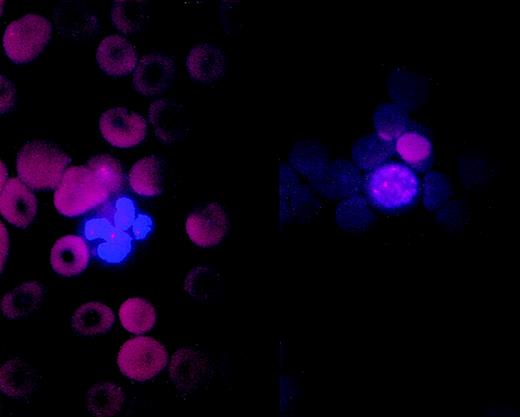 Fig. 2. A (left) neutrophil and an (right) erytroblast from pretransplant bone marrow smear of patient no. 6 showing trisomy 8.