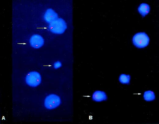 Fig. 4. Cells from patient no. 1 harvest. Arrows indicate (A) monosomy 11 cells and (B) monosomy 7 cells.