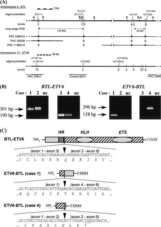 Fig. 1. RT-PCR and schematic representation of the results. (A) Genomic structure of BTL and ETV6. The position of the PAC clones covering BTL was determined by Southern hybridization using oligonucleotides derived from the exon sequences (•, positive by hybridization; ○, negative by hybridization). The genomic structure of ETV6 was taken from Baens et al.12 The different primers used for PCR are shown in italics above the respective genomic structures. Exons are represented by gray boxes. E, EcoRI; H, HindIII. (B) Detection of the BTL-ETV6 and ETV6-BTL transcripts in the 4 cases by RT-PCR. Only the results of the second-round PCR are shown. nc, negative control. (C) Schematic representation of the predicted fusion proteins. Sequences derived from ETV6 are drawn in italics. Arrowheads mark the bounderies between the ETV6 and BTL parts. HR, hydrophobic region of BTL; HLH, helix-loop-helix domain of ETV6; ETS, DNA binding domain of ETV6.