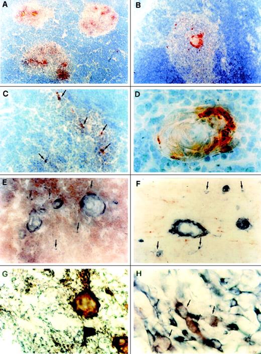 Fig. 1. Distribution of MDC in the human thymus. (A) Selective MDC expression in the medullary areas. The section was immunostained with anti-MDC monoclonal antibody using the avidin-biotin-peroxidase method and the AEC substrate (red color; original magnification × 40). (B) MDC immunostaining in the medulla is clearly visible in cells of the outer layer of a Hassal’s corpuscle and in the other cells scattered throughout the medulla (red color; original magnification × 100). (C) High power magnification of cells scattered in the medulla (shown by arrows) showing MDC immunostaining (red color; original magnification × 250). (D) High power magnification of a Hassal’s corpuscle showing strong MDC immunoreactivity (original magnification × 1,000). (E) Double immunostaining for MDC (blue-gray) and CD3 (red); individual cells staining for MDC but not CD3 are shown by arrows (original magnification × 250). (F) Double immunostaining for MDC (blue-gray) and PAM-1 (red) showing clear cut separation between MDC-positive Hassal’s corpuscles or single cells (arrows) and macrophage dendritic cells (original magnification × 250). (G) Double immunostaining for MDC (red) and cytokeratin (blue-gray). Hassal’s corpuscles and some cells staining for both MDC and cytokeratin (purple-brown), as well as many cells staining for cytokeratin alone (blue-gray) are visible (original magnification × 250). (H) Higher magnification of medullary cells showing double immunostaining for MDC and cytokeratin (purple-brown; indicated by arrows) or cytokeratin alone (blue-gray; original magnification × 1,000). (A) through (D) were counterstained with Gill’s hematoxylin, whereas no counterstain was applied in (E) through (H).