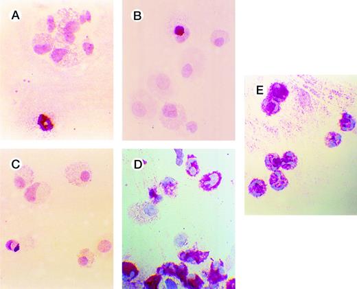 Fig. 6. Effects of oligonucleotides on differentiation of CD34+ cells induced with FL plus IL-3 assayed by immunocytochemistry. Cells at an initial concentration of 5,000/mL were incubated in medium supplemented with FL at 50 ng/mL and IL-3 at 25 ng/mL to promote monocytic differentiation. On days 0, 5, and 10, antisense RB oligonucleotides (AS2), sense-orientated oligonucleotides (SO2), scrambled oligonucleotides (SCR), or oligo buffer were added, each time at a concentration of 5.0 μmol/L. After 14 days, cytospin slides were subjected to immunochemistry using antibodies to human lactoferrin, as described in Materials and Methods. Red-colored cytoplasm indicates the presence of lactoferrin, a granulocyte-specific protein. Cells incubated with FL, IL-3, and buffer (A); with FL, IL-3, and SO2 (B); with FL, IL-3, and SCR (C); with FL, IL-3, and AS2 (D); and human neutrophils (E).