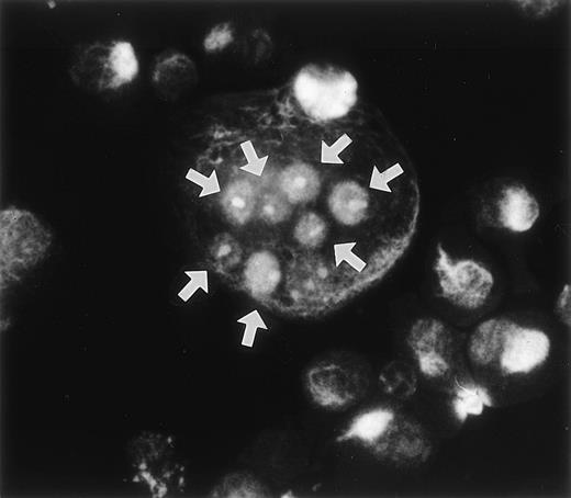 Fig. 1. Immunoreactivity of the MoAb Kat 6 to multinucleated cells formed in bone marrow culture. Rat bone marrow cells were cultured in the presence of htROSCM and 10−8 mol/L 1,25(OH)2D3 for 5 days. The detached cells were centrifuged onto a glass slide by using a cytospin, fixed with 2% PFA, and stained by MoAb Kat 6 using FITC-conjugated antimouse IgM as the second antibody. Positive signals in the nucleus of the multinucleated cells in the culture are indicated by arrows. (Original magnification × 443.)