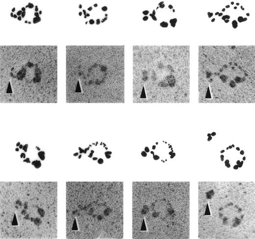 Fig. 4. ImmunoEM appearance of defensin/Lp(a) complex. Electron micrographs of defensin/Lp(a) complexes. Lp(a) was incubated alone or in the presence of 1:10 molar ratio of defensin for 30 minutes at 22°C followed by incubation with anti-defensin sera for 30 minutes at 22°C. All specimens were rotary shadowed with tungsten. A gallery of selected examples of individual Lp(a) molecules attached to anti-defensin antibody in the presence and absence (lower panel, far right) of defensin is shown. No binding was seen when nonimmune sera was substituted for anti-defensin sera. The arrows denote the location of the anti-defensin antibodies.