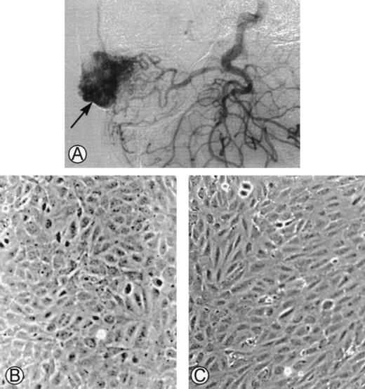 Fig. 1. (A) Angiogram of one of the cephalic arteriovenous malformations. The vascular tumor was embolized using an endovascular technique and was operated on. The specimen was used as starting material to obtain endothelial cells derived from the malformation. (B) Phase-contrast microphotographs of confluent HUVEC or (C) confluent AMEC grown on gelatin-coated plastic dishes (original magnification ×100).