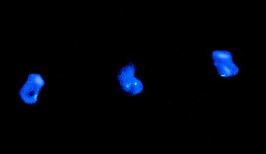 Fig. 2. Genotype of CD80-sorted, leukemia-derived DC (patient TA). The figure shows DAPI counterstained nuclei from a CD80-sorted positive culture of leukemia-derived DC hybridized with a chromosome 7-satellite (green signal) probe. Cells with 1 signal indicating monosomy 7 or 2 signals indicating the normal pattern are shown.