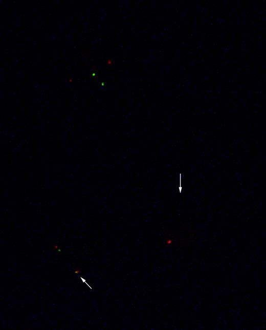 Fig. 6. Genotype of CD83-sorted, Ph+leukemia-derived DC (patient AB). The figure shows interphase nuclei from a CD83-sorted positive culture of leukemia-derived DC. A normal interphase nucleus shows 2 orange (bcr) and 2 green (abl) signals. Nuclei with bcr-abl fusion show 1 orange signal (bcr), 1 green signal (abl), and the fusion (bcr-abl) orange and green signal (arrow).