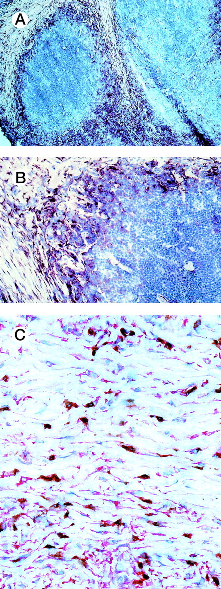 Fig. 1. Immunohistology of HD tissues. Immunohistology of frozen sections of nodular sclerosis subtype of HD stained for eotaxin using a monoclonal anti-eotaxin antibody (red reaction product-APAAP technique). (A and B) Eotaxin-expressing cells are located within the collagen tissue bands. Hodgkin/Reed-Sternberg cells and other reactive cells are eotaxin negative. (C) Double labeling for CD3 (brown reaction product-streptavidin/biotin method) and eotaxin in a case of nodular sclerosing classical HD shows that most of the spindle-shaped eotaxin-expressing cells do not coexpress CD3.