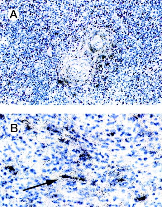 Fig. 2. In situ hybridization of HD lymph nodes. In situ hybridization with eotaxin antisense probe is shown. Eotaxin-specific signals are found around blood vessels. Labeled cells were also observed in the cellular infiltrates. Using morphology, these cells may represent fibroblasts or, in some cases, macrophages (solid arrow).