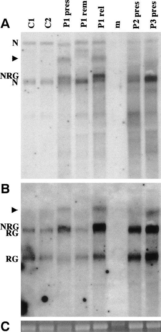 Fig. 5. Northern analysis of NRG expression. (A) Hybridization using a NUP98 cDNA probe. (B) Hybridization of the same membrane with a RAP1GDS1 cDNA probe. (C) 18S rRNA from the ethidium bromide-stained gel before transfer. RNA was isolated from 2 normal controls (C1 and C2) and from the 3 patients (P1, P2, and P3). pres is a presentation sample, rem is a remission sample, and rel is a relapse sample. Each lane contains 5 μg of total RNA from peripheral blood mononuclear cells, except that P1 rem contains 5 μg of total RNA from bone marrow. The lane marked m is a RNA ladder (Promega). The band in this lane in (C) is marker and not 18S RNA. N indicates theNUP98 4.05- and 7.25-kb bands. The 7.25-kb band is a precursor that also contains the NUP96 coding sequence.47 RG indicates the 2.8- and 4.1-kb RAP1GDS1 bands. NRG indicates the 4.4-kb NRG transcript. NRG2 in patient no. 3 is not indicated, because it is not distinguishable from the 4.05-kbNUP98 and 4.1-kb RAP1GDS1 bands. The arrowheads indicate higher molecular weight transcripts that hybridize with both the NUP98 and RAP1GDS1 probes.