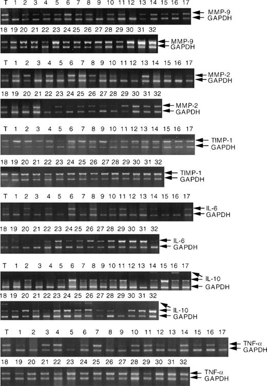 Fig. 1. RT-PCR analysis of MMP-9, MMP-2, TIMP-1, IL-6, IL-10, and TNF- mRNA expression in NHL and tonsil (T). RNA extraction and RT-PCR analysis were performed as described in Materials and Methods. NHL are described (cases 1 to 32) in Materials and Methods. Each analysis was internally controlled by inclusion of GAPDH primers for the last 20 cycles of PCR.