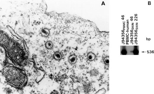 Fig. 4. Detection of HVMNE in the cell lines J94356PBMC and J94356SKIN by electron microscopy and DNA PCR. (A) EM of cell line J94356PBMCharvested 48 hours after induction with Na-butyrate (1 μmol/L). Extensive EM search in the same cell line without Na-butyrate induction failed to show viral particles (not shown). (B) Southern blot of PCR products using probe 536. Detection of a 536-bp DNA fragment in the J94356PBMC and J94356SKIN cell lines at 46 days in culture and after 226 days in culture in line J94356SKINby PCR using the generic primer pair DFASA/GDTD1B (described by Rose et al33).