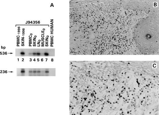Fig. 10. Detection of herpesvirus DNA by PCR and of EBV-specific RNA by in situ hybridization in tissues of animal J94356. (A) Southern blot of PCR products using probe p536. Detection of 536-bp and 236-bp DNA fragments in tissues from animal J94356 by PCR using primer pairs DFASA/GDTD1B (top) and VYGA/GDTD1B (bottom) at 2 time points. Lanes 1 and 2, PCR results on DNA obtained from noncultured PBMC and affected skin approximately 7 weeks before death (1996). Lanes 3 through 8, PCR products on DNA obtained from animal J94356 at time of necropsy (time 0). Lane 3, PBMC, noncultured; lane 4, affected skin; lane 5, lymph node; lane 6, muscle; lane 7, normal skin. Lane 8, negative control (DNA from normal human PBMC). EBV EBER in situ hybridization performed on sections of affected skin biopsy at low (B) and high (C) magnification. A large number of cells expressing EBV EBER RNA are found infiltrating the dermis and epidermis in the lymphomatous animal.